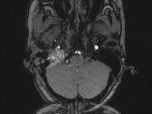 Bilateral carotid body tumors and right glomus jugulare tumor (Radiopaedia 20024-20060 Axial MRA 310).jpg