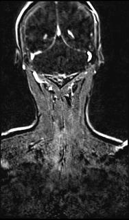 File:Bilateral carotid body tumors and right glomus jugulare tumor (Radiopaedia 20024-20060 MRA 135).jpg