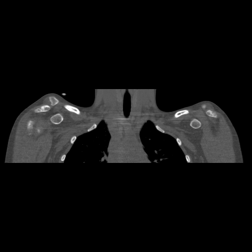 Bilateral chronic posterior shoulder dislocation (Radiopaedia 39213-41452 Coronal bone window 18).jpg