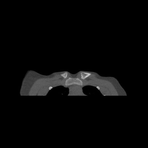 Bilateral chronic posterior shoulder dislocation (Radiopaedia 39213-41452 Coronal bone window 3).jpg