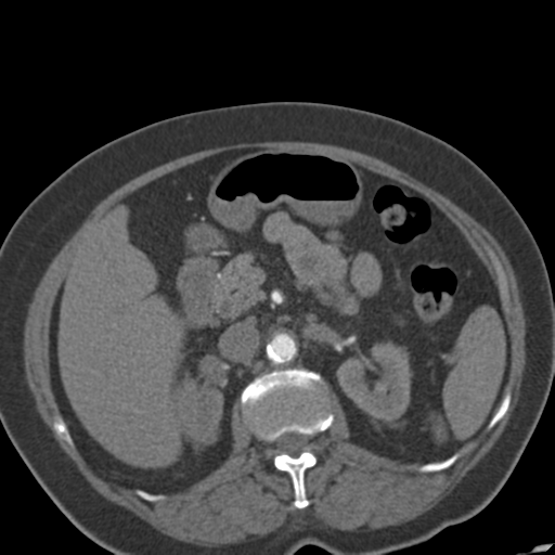 Bilateral delayed nephrogram from renal artery stenosis (Radiopaedia 47681-52362 A 22).png