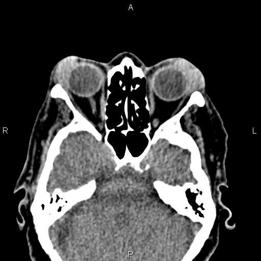 File:Bilateral enlargement of lacrimal glands - sarcoidosis (Radiopaedia 62627-70921 Axial non-contrast 42).jpg