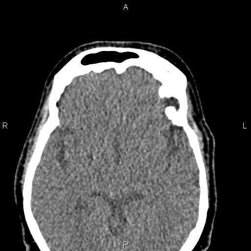 Bilateral enlargement of lacrimal glands - sarcoidosis (Radiopaedia 62627-70921 Axial non-contrast 70).jpg