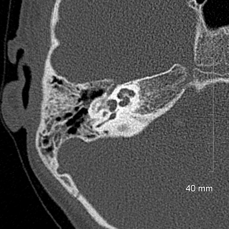Bilateral grommets (Radiopaedia 47710-52404 Axial bone window 40).jpg