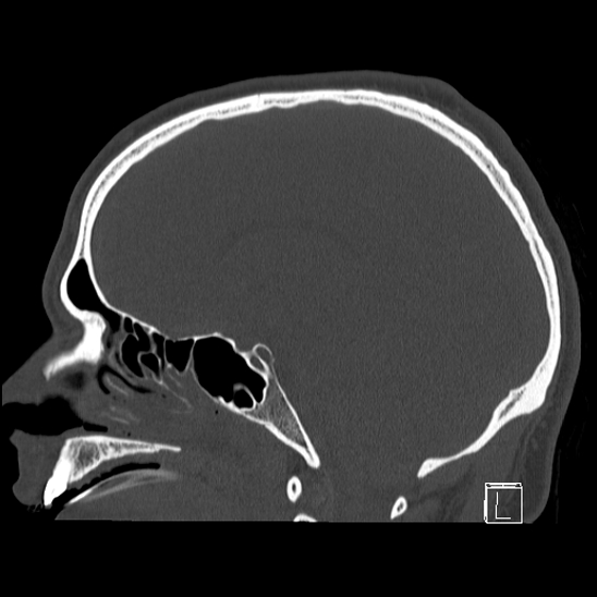 Bilateral occipital condyle fracture (type 2) (Radiopaedia 87675-104089 Sagittal bone window 61).jpg