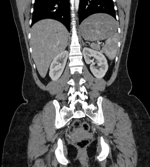 Bilateral ovarian mature cystic teratomas (Radiopaedia 79373-92457 B 66).jpg