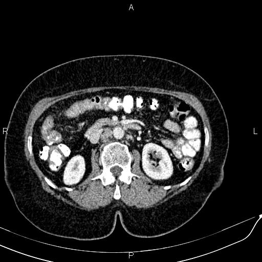 Bilateral ovarian serous cystadenocarcinoma (Radiopaedia 86062-101989 B 44).jpg
