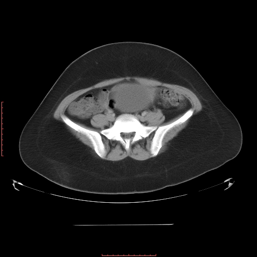 File:Bilateral ovarian serous cystadenocarcinoma with right ovarian torsion (Radiopaedia 32640-33611 A 30).jpg