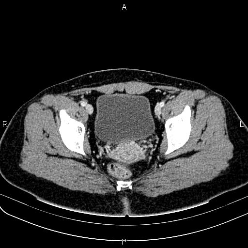 Bilateral ovarian teratoma (Radiopaedia 83131-97503 Axial With contrast 57).jpg