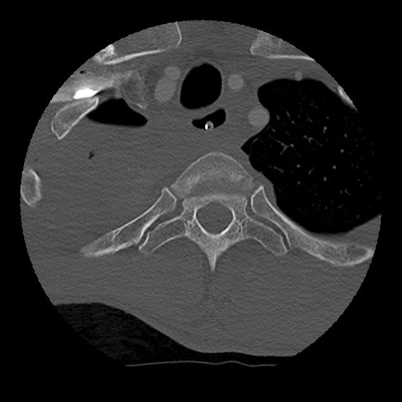File:Bilateral perched facets with cord injury (Radiopaedia 45587-49713 Axial bone window 111).jpg