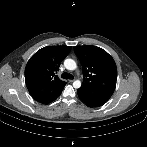 Bilateral pulmonary AVM (Radiopaedia 83134-97505 A 26).jpg
