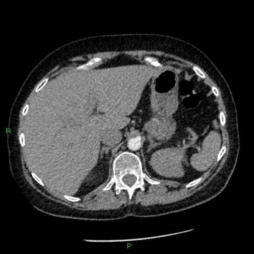 Bilateral pulmonary emboli (Radiopaedia 32700-33669 Axial C+ CTPA 104).jpg