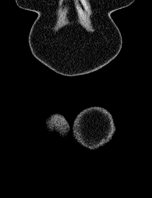 Bilateral staghorn calculi (Radiopaedia 59475-66842 Coronal non-contrast 25).jpg
