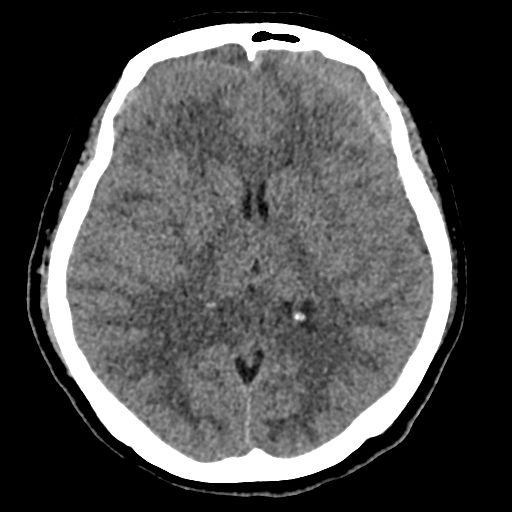 Bilateral subacute subdural hematoma (Radiopaedia 69240-79018 Axial non-contrast 25).jpg