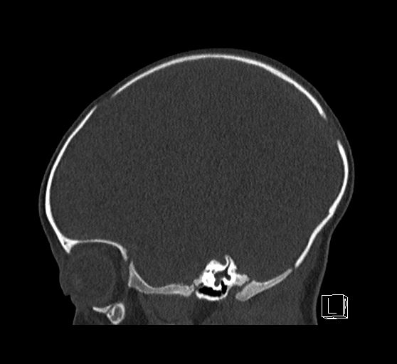 Bilateral subdural hemorrhage and parietal skull fracture (Radiopaedia 26058-26192 Sagittal bone window 28).png