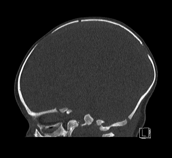 Bilateral subdural hemorrhage and parietal skull fracture (Radiopaedia 26058-26192 Sagittal bone window 58).png