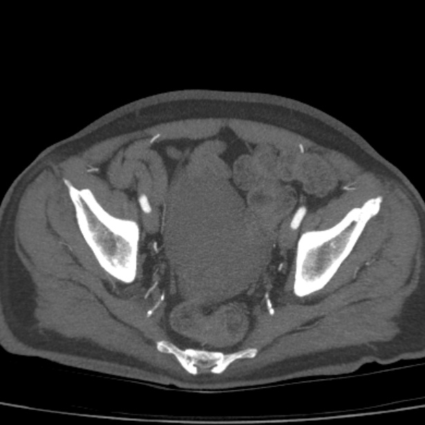 Bilateral superficial femoral arterial occlusion (Radiopaedia 25682-25857 A 22).jpg