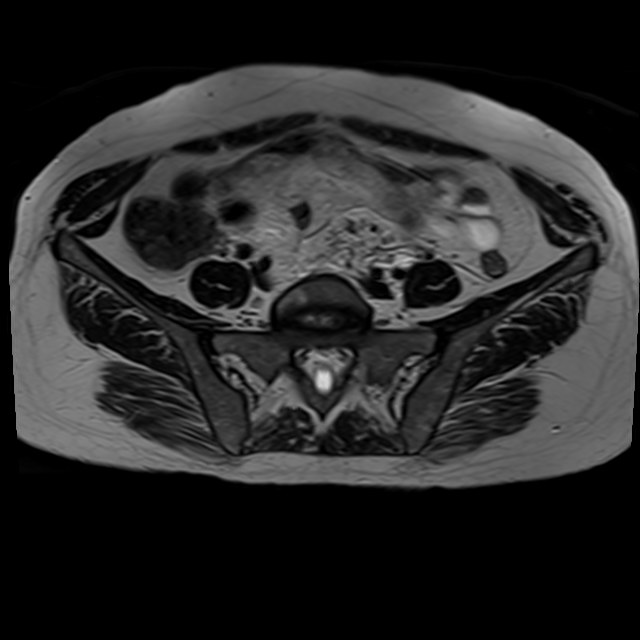 Bilateral tubo-ovarian abscesses (Radiopaedia 58635-65829 Axial T2 5).jpg