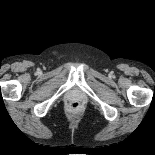 Bladder tumor detected on trauma CT (Radiopaedia 51809-57609 C 146).jpg