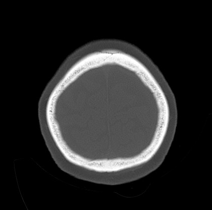 Blood on the tentorium simulating hyperdense transverse sinus (Radiopaedia 55521-61991 Axial bone window 45).jpg