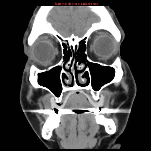 File:Blowout fracture with inferior rectus entrapment (Radiopaedia 12418-12673 Coronal non-contrast 6).jpg