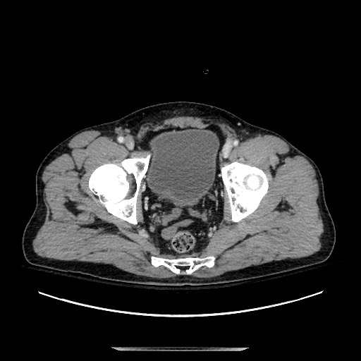 Blunt abdominal trauma with solid organ and musculoskelatal injury with active extravasation (Radiopaedia 68364-77895 A 143).jpg