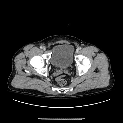 Blunt abdominal trauma with solid organ and musculoskelatal injury with active extravasation (Radiopaedia 68364-77895 A 144).jpg
