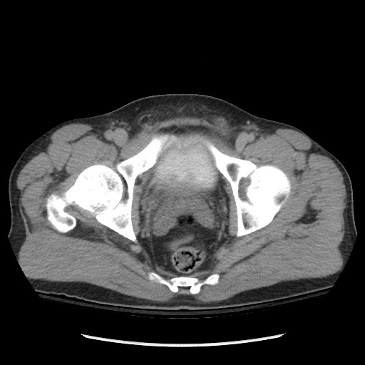 Blunt abdominal trauma with solid organ and musculoskelatal injury with active extravasation (Radiopaedia 68364-77895 Axial C+ delayed 130).jpg