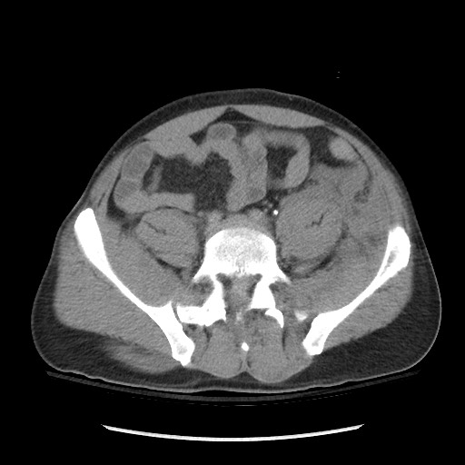 Blunt abdominal trauma with solid organ and musculoskelatal injury with active extravasation (Radiopaedia 68364-77895 Axial C+ delayed 99).jpg