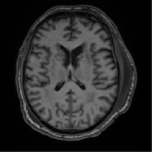 File:Blunt cerebrovascular injury (Radiopaedia 53682-59745 Axial T1 19).png