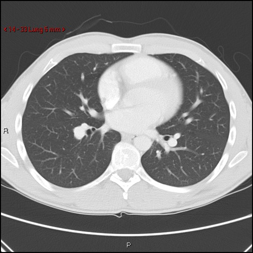 Blunt chest trauma - pulmonary interstitial emphysema and pneumomediastinum (Radiopaedia 20666-20552 Axial lung window 33).jpg
