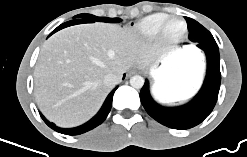 Blunt injury to the small bowel (Radiopaedia 74953-85987 A 4).jpg