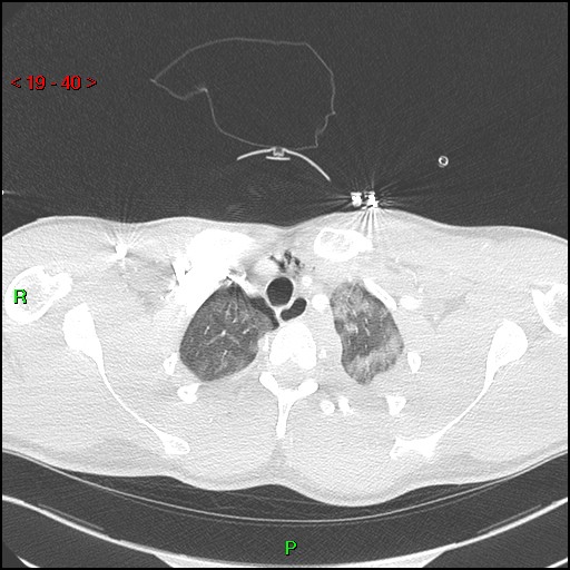 Blunt thoracic trauma (Radiopaedia 73454-84221 Axial lung window 15).jpg