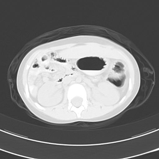 File:Bochdalek diaphragmatic hernia (Radiopaedia 38866-41059 Axial lung window 29).jpg