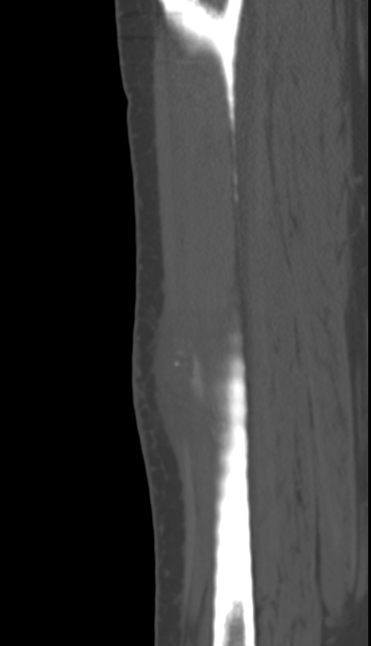 Bone metastasis - tibia (Radiopaedia 57665-64609 Sagittal bone window 115).jpg