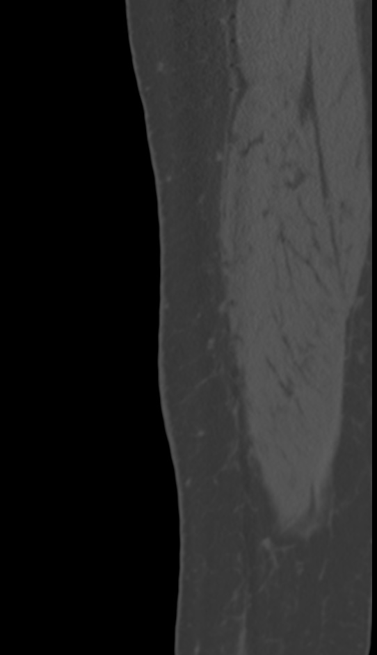 Bone metastasis - tibia (Radiopaedia 57665-64609 Sagittal bone window 6).jpg