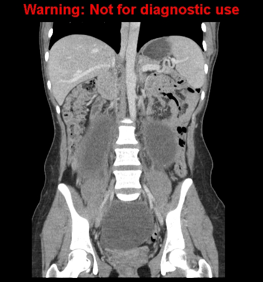 Borderline mucinous cystadenoma of ovary (Radiopaedia 25586-25767 B 39).jpg