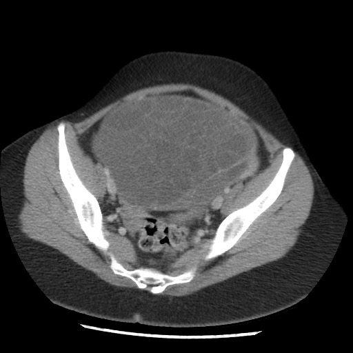 File:Borderline mucinous tumor (ovary) (Radiopaedia 78228-90808 A 122).jpg