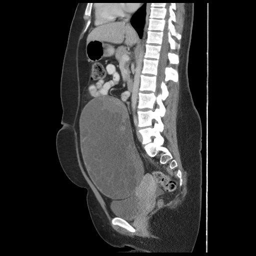 File:Borderline mucinous tumor (ovary) (Radiopaedia 78228-90808 B 37).jpg