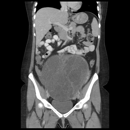 Borderline mucinous tumor (ovary) (Radiopaedia 78228-90808 C 25).jpg