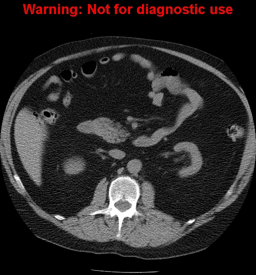 File:Bosniak renal cyst - type IV (Radiopaedia 23402-23466 Axial non-contrast 11).jpg