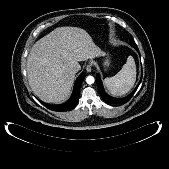 File:Bosniak renal cyst - type IV (Radiopaedia 24244-24518 B 43).jpg