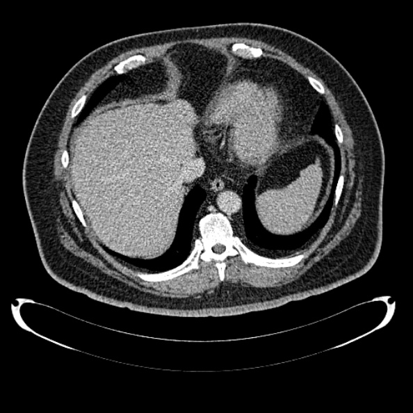 Bosniak renal cyst - type IV (Radiopaedia 24244-24518 C 24).jpg
