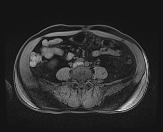 Bouveret syndrome (Radiopaedia 61017-68856 Axial T1 fat sat 64).jpg