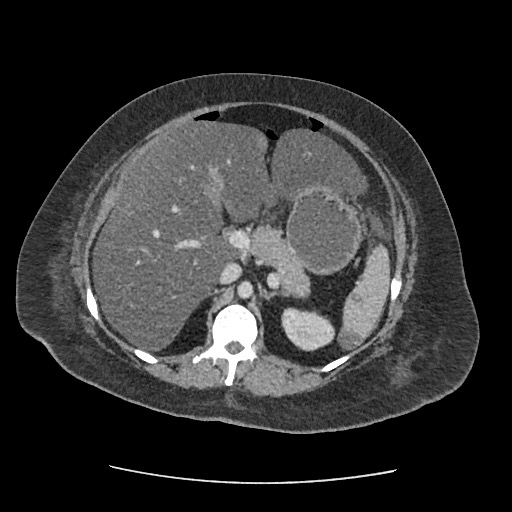Bowel and splenic infarcts in acute lymphocytic leukemia (Radiopaedia 61055-68915 A 50).jpg