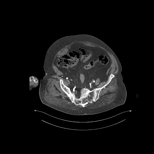 File:Bowel ischemia secondary to SMA occlusion with extensive portomesenteric venous gas (Radiopaedia 54656-60871 A 8).jpg