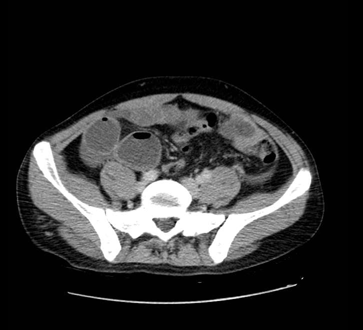 Bowel obstruction from colon carcinoma (Radiopaedia 22995-23028 A 61).jpg