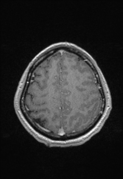 Brain abscess with ventriculitis (Radiopaedia 85703-101495 Axial T1 C+ 137).jpg