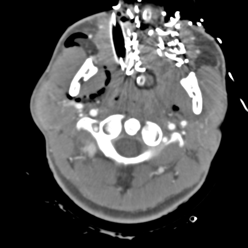 File:Brain contusions, internal carotid artery dissection and base of skull fracture (Radiopaedia 34089-35339 D 57).png