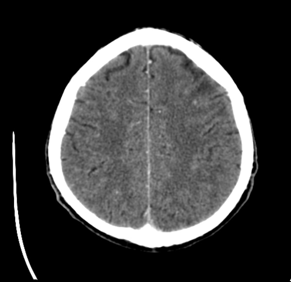 File:Brain metastases from lung cancer (Radiopaedia 24480-24781 Axial C+ delayed 46).jpg
